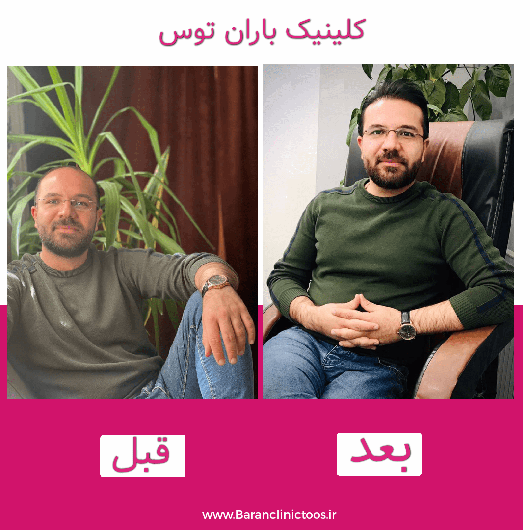 قبل و بعد کاشت مو